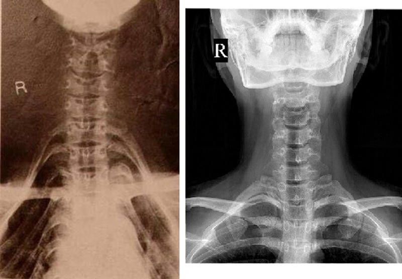 Two side-by-side X-ray images. The x-ray on the left represents an extended neck. The collarbone has been pressed down away from the neck bones, giving the illusion of an elongated neck. The x-ray image on the right shows the "normal" skeletal structure of the neck with no extensions.