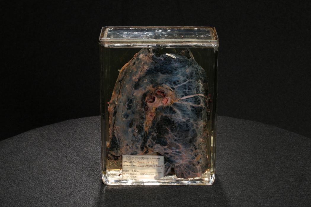 Encased coal miner's lung