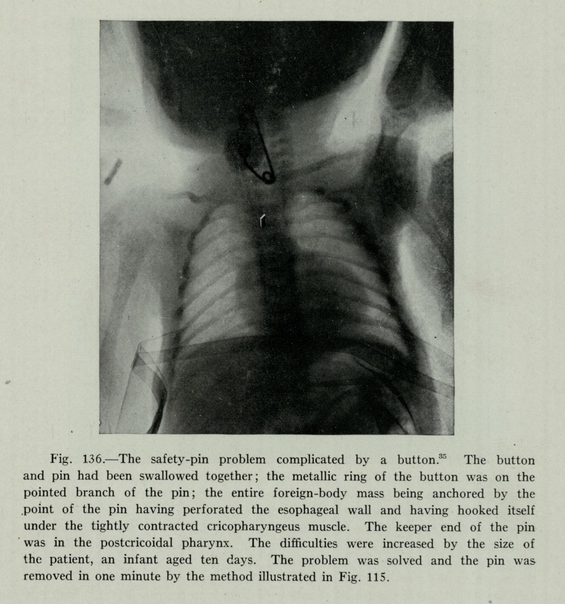 X-ray showing safety pin and button in a 10-day-old infant’s airway