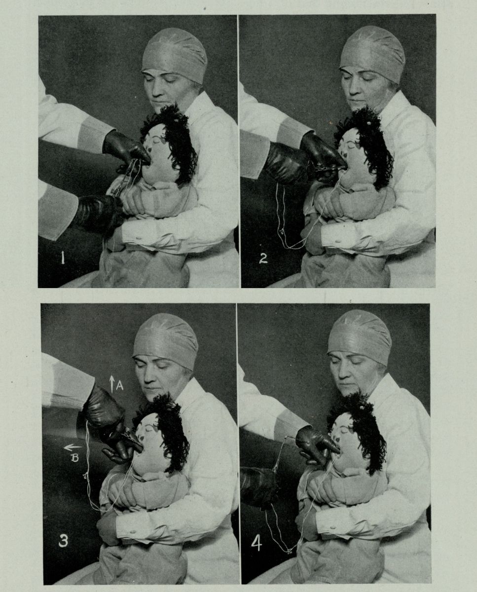 A picture of Chevalier Jackson “operating” on Michelle the Choking Doll